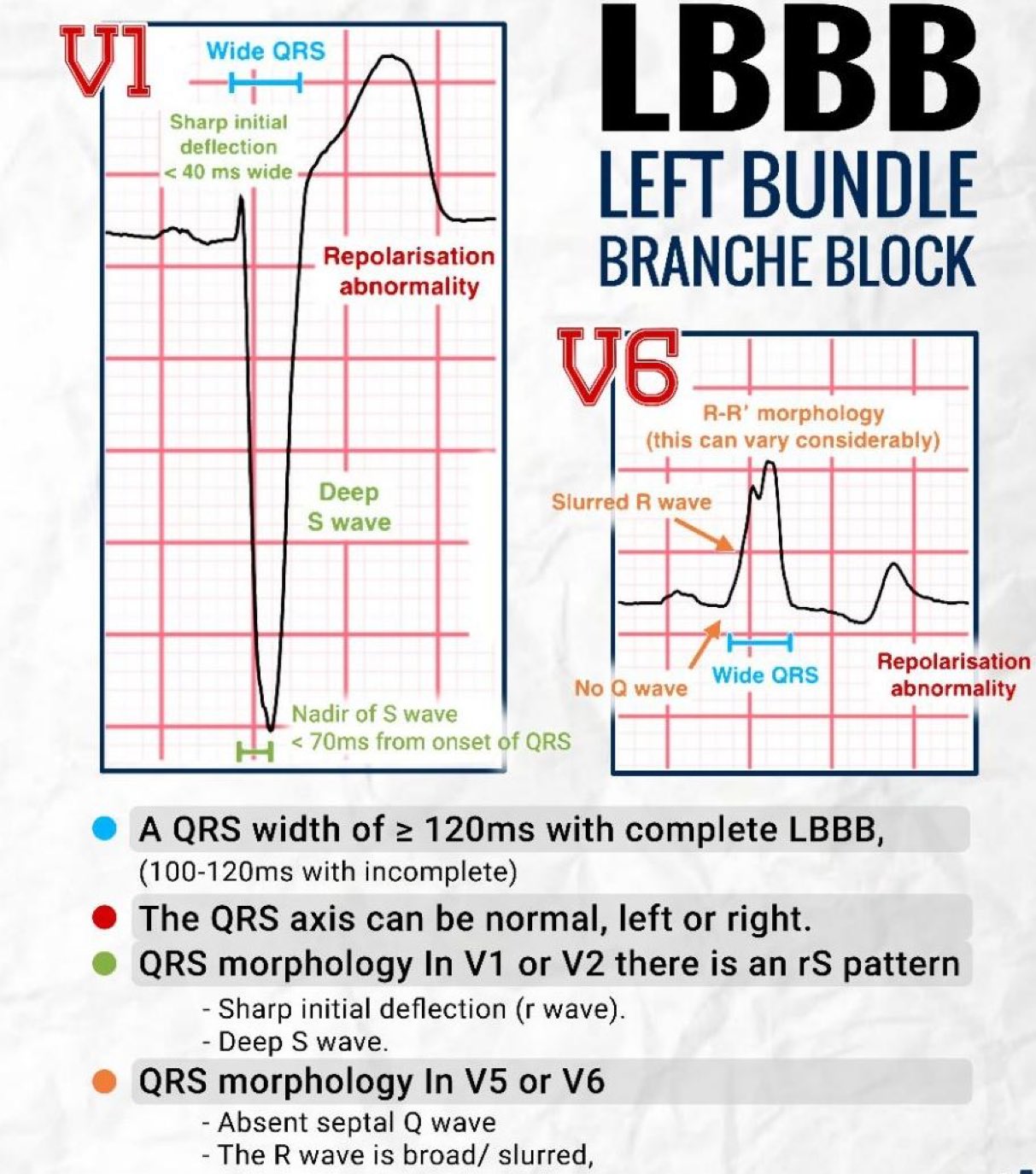 EKG Central - ⚫️ LBBB ⚫️ Left Bundle Branch Block ⚫️...