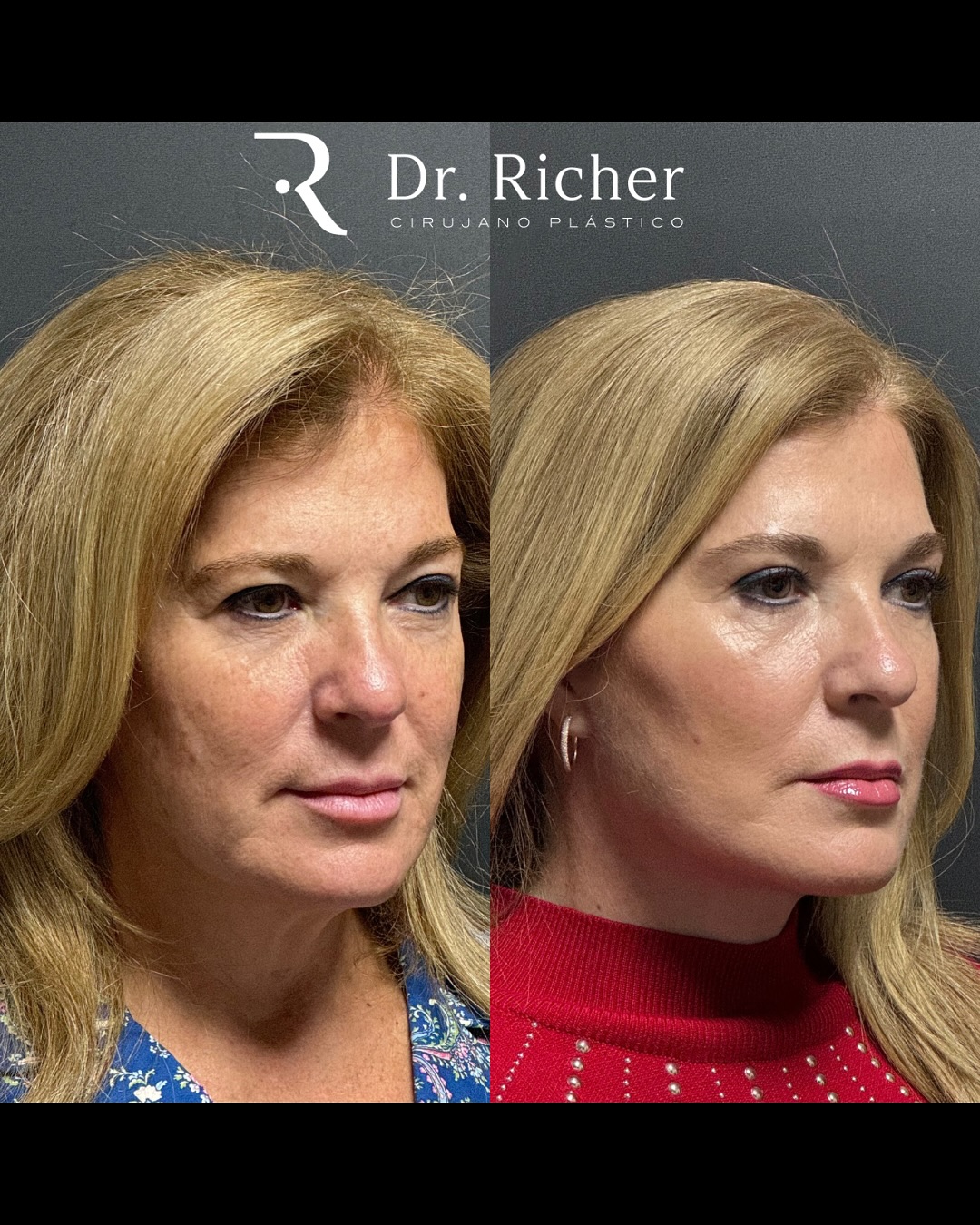 Dr. Richer Cirujano Plástico | San Pedro Garza Garcia