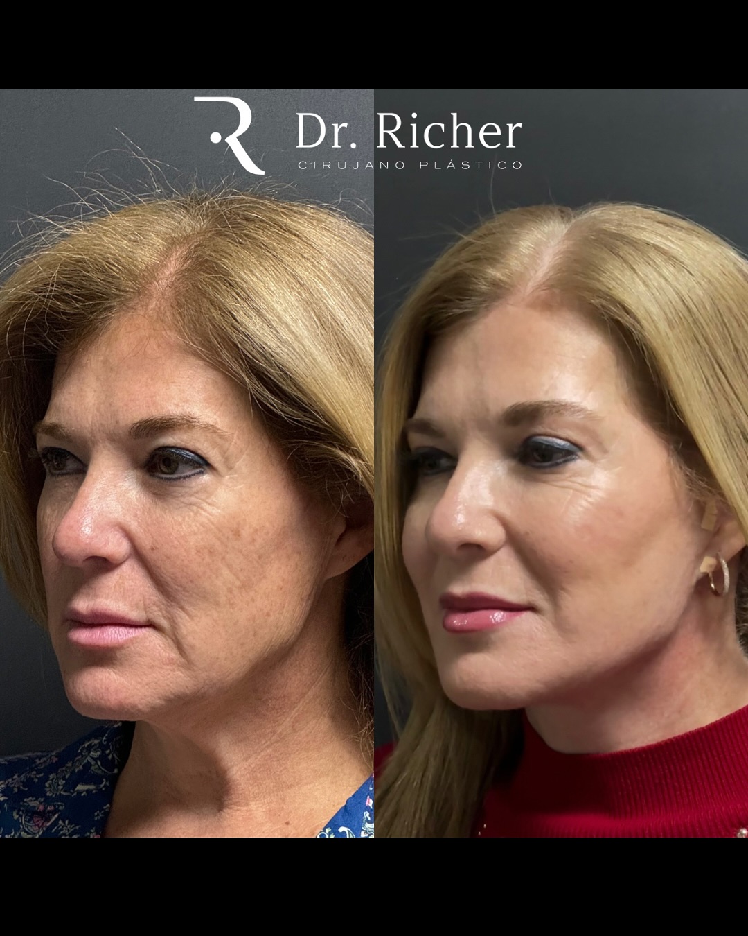 Dr. Richer Cirujano Plástico | San Pedro Garza Garcia
