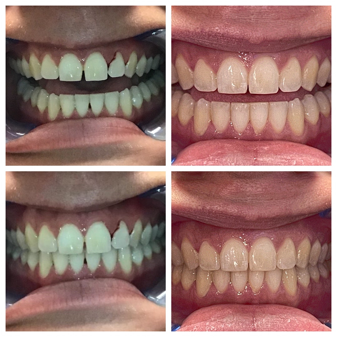 Heartland Family Dental Care - 👀 Check out this Invisalign before and ...