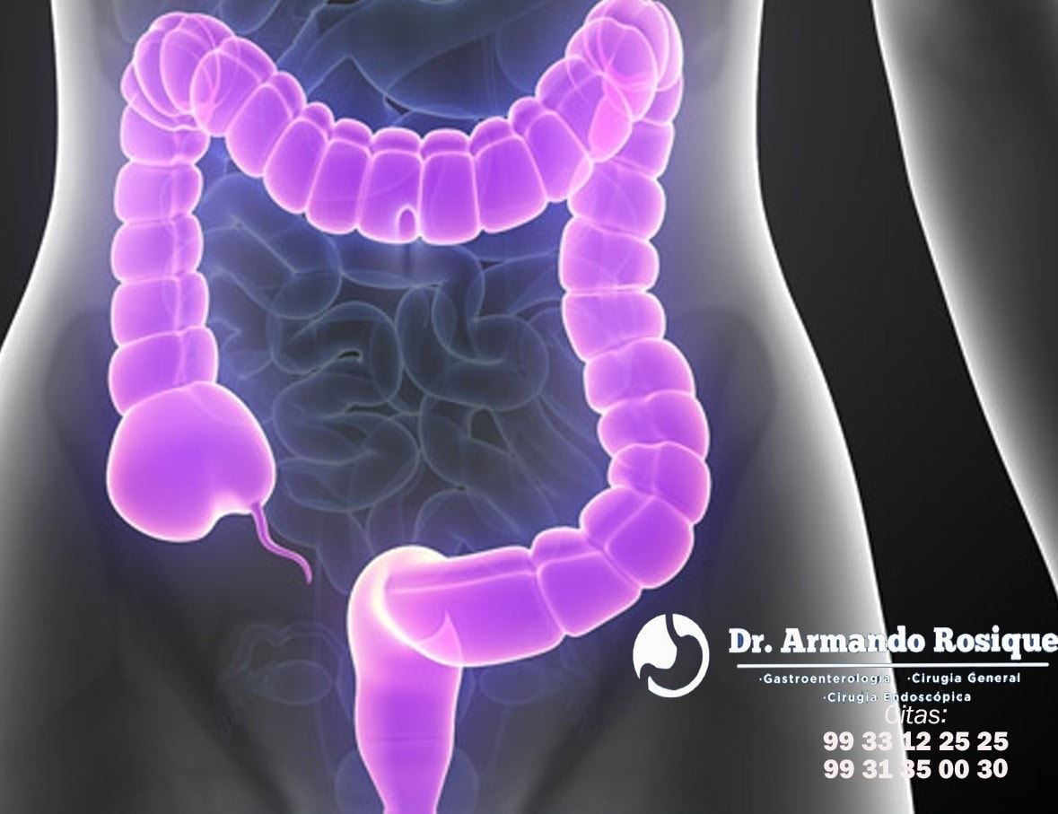 Causas y síntomas de la colitis La mayoría de las veces, la causa de la ...
