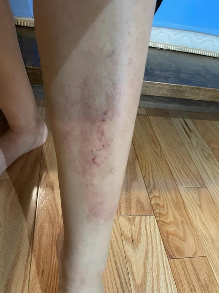 SKIN RASH, LONG CVD,... - Acupuncture Wellness Services, PLLC | Facebook