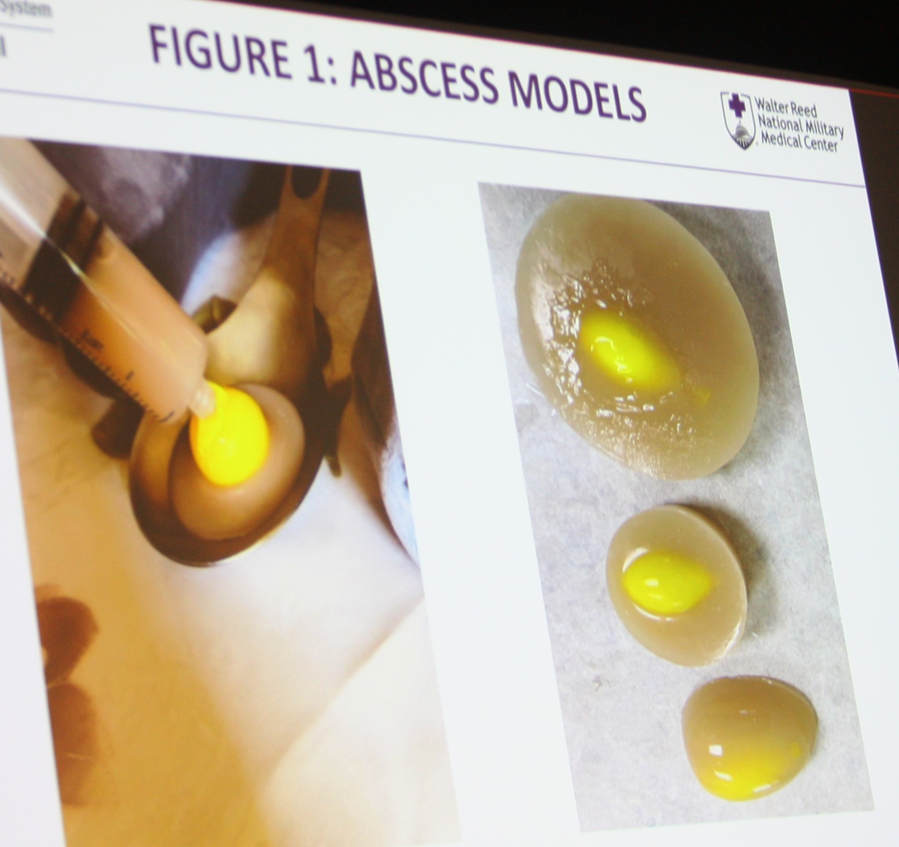 Walter - A model of an abscess developed by a team of researchers at ...