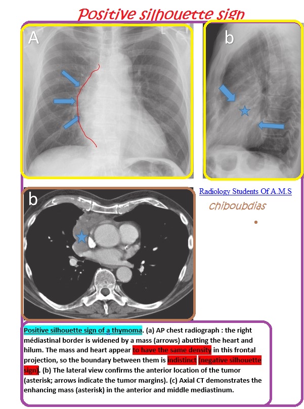 Positive silhouette sign... - Radiology Students Of A.M.S | Facebook