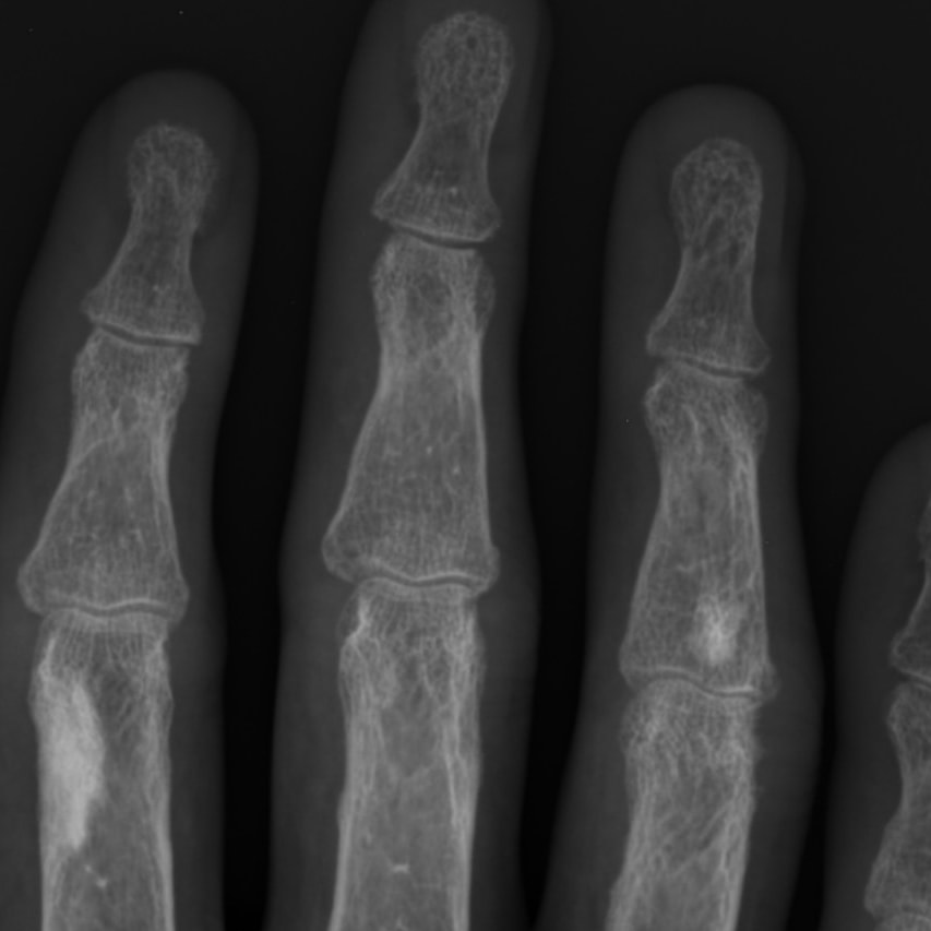 Radiopaedia.org - 🎯Hand x-rays: Cortical-based focal areas...