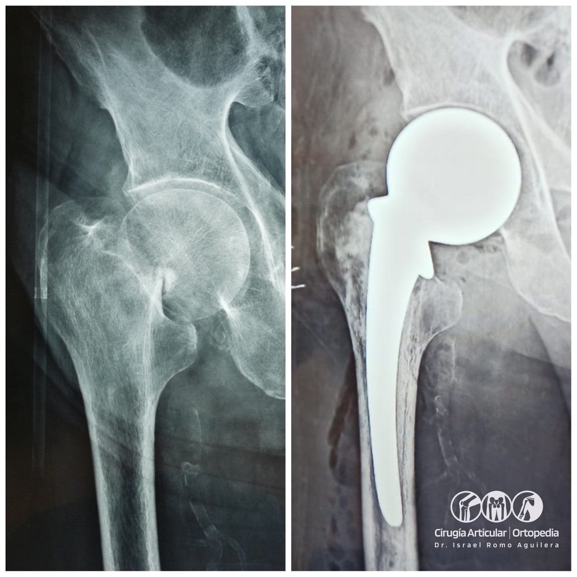 Cirugía Articular, Ortopedia y Traumatología - Dr. Israel Romo ...