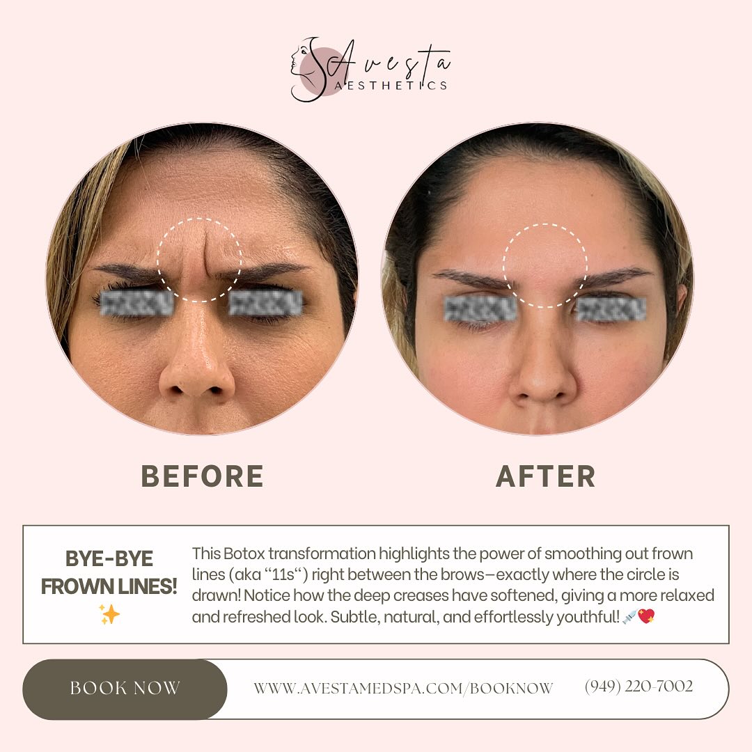 Bye-Bye Frown Lines, Hello Glow! ... - Avesta Aesthetics | Facebook