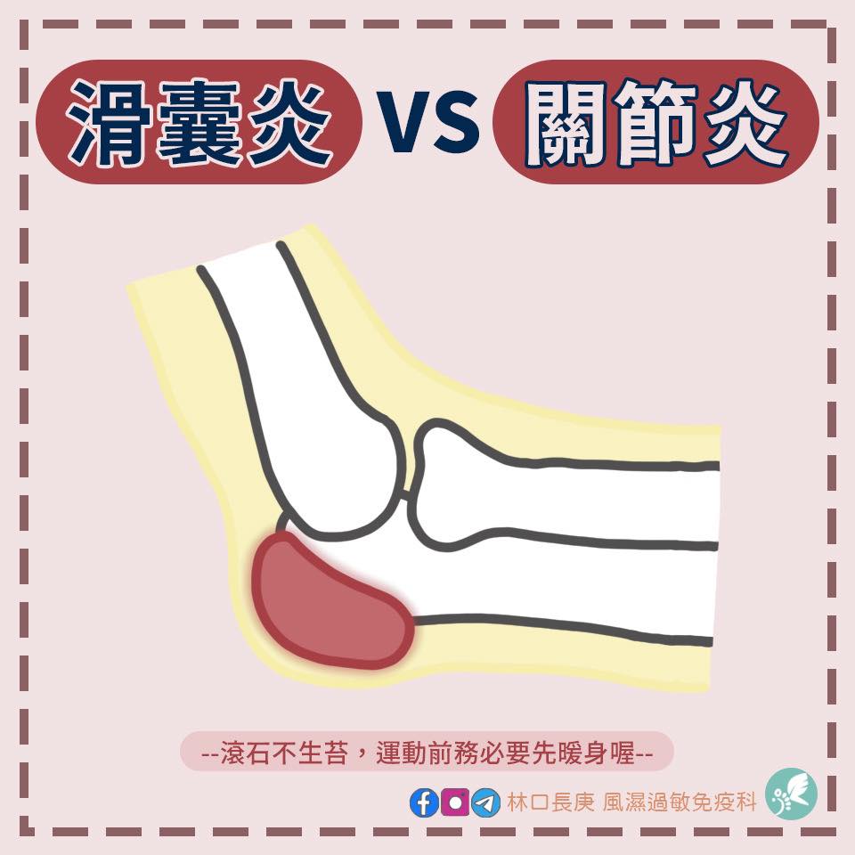 林口長庚風濕過敏免疫科 - 滑囊炎 vs 關節炎 滑囊炎是一種很常見的骨關節疾病， 人體大約有150個滑囊，...