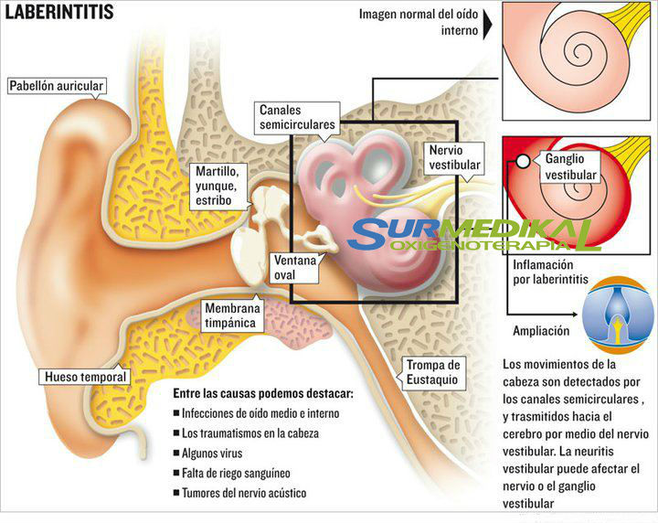 LABERINTITITS Inflamación del... - Surmedikal Oxigenoterapia