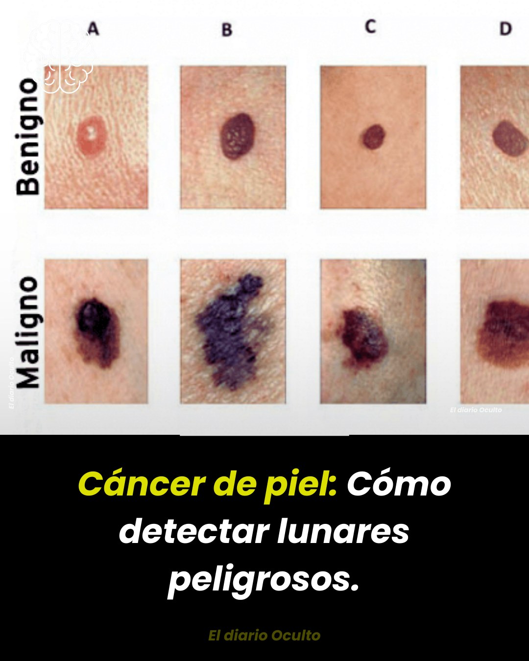 El - CÁNCER DE PIEL: CÓMO DETECTAR LUNARES PELIGROSOS El cáncer de piel ...