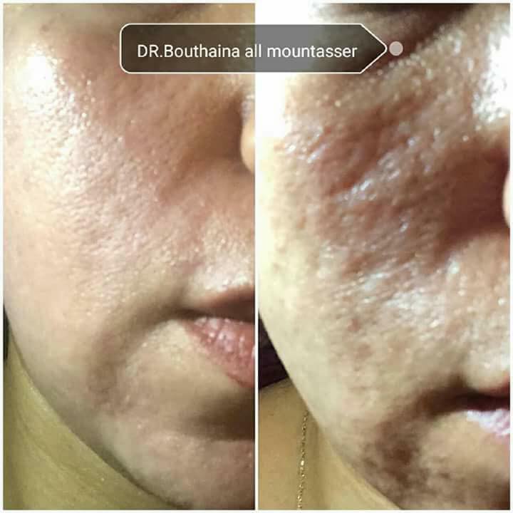 ديرما بن ميزوثيرابي سكار فري Derma Care Center Facebook