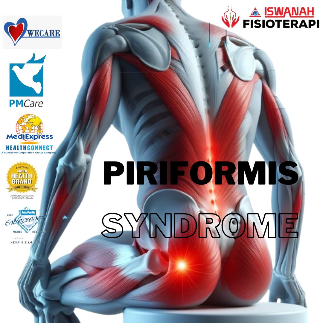 Piriformis Syndrome is a... - Iswanah Physiotherapy Bangi | Facebook