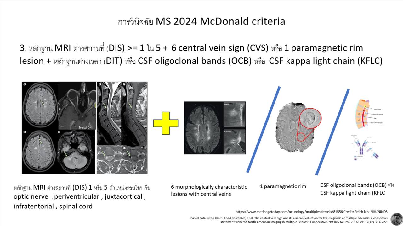 Juxtacortical And Periventricular Lesions
