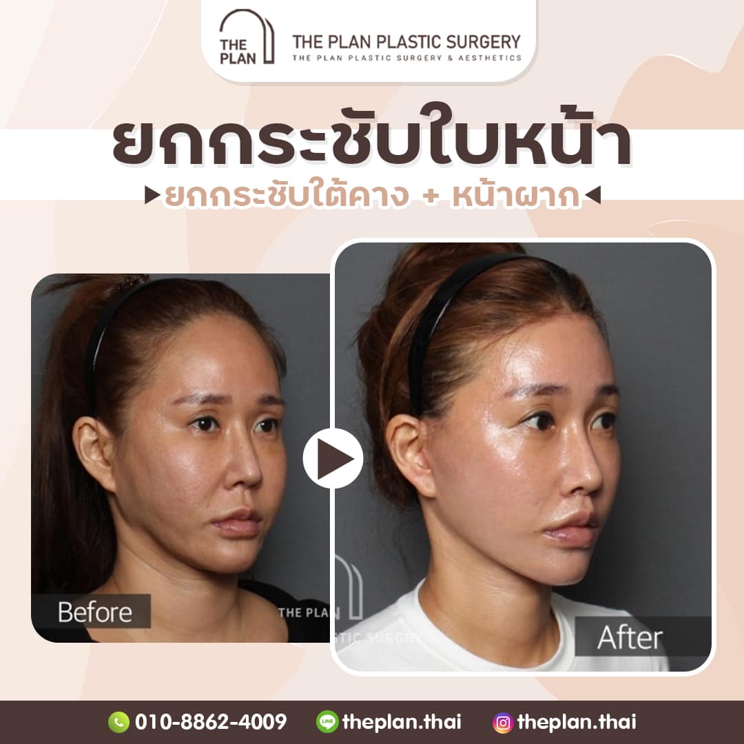 ศัลยกรรมเกาหลี โรงพยาบาลเดอะแพลนท์ | Seoul