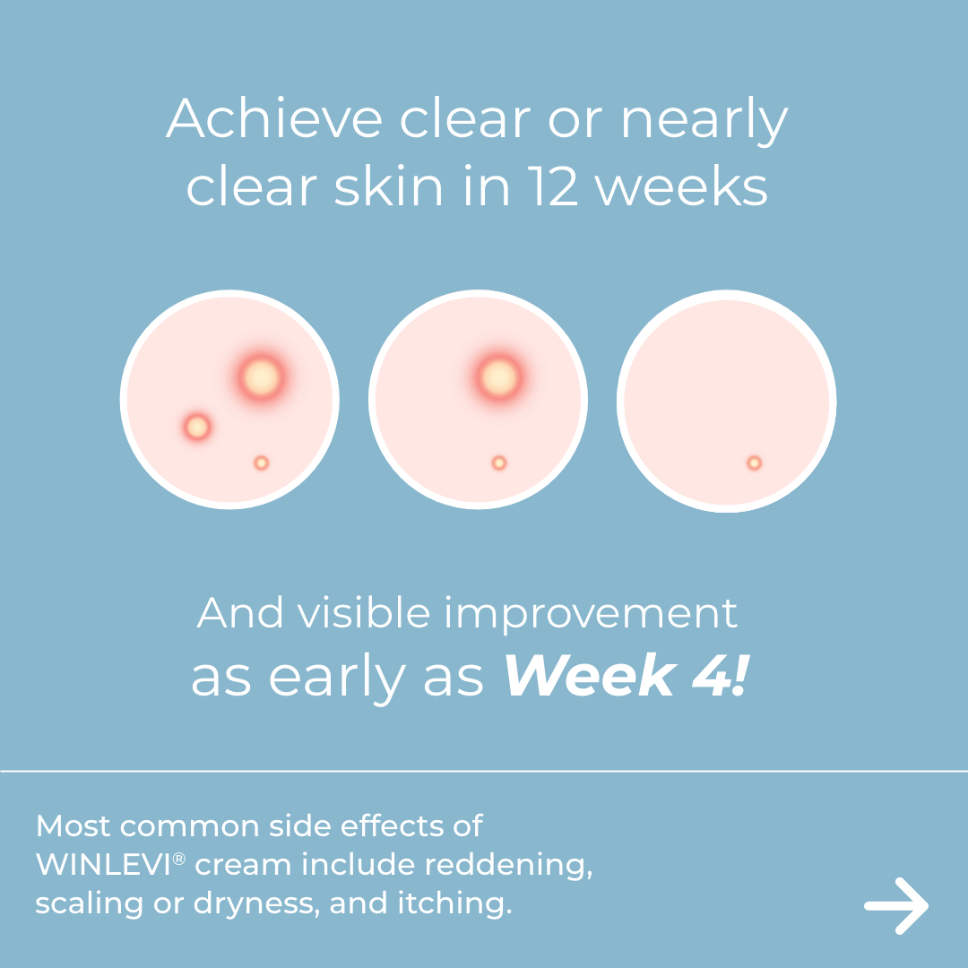 WINLEVI® (clascoterone) cream 1%