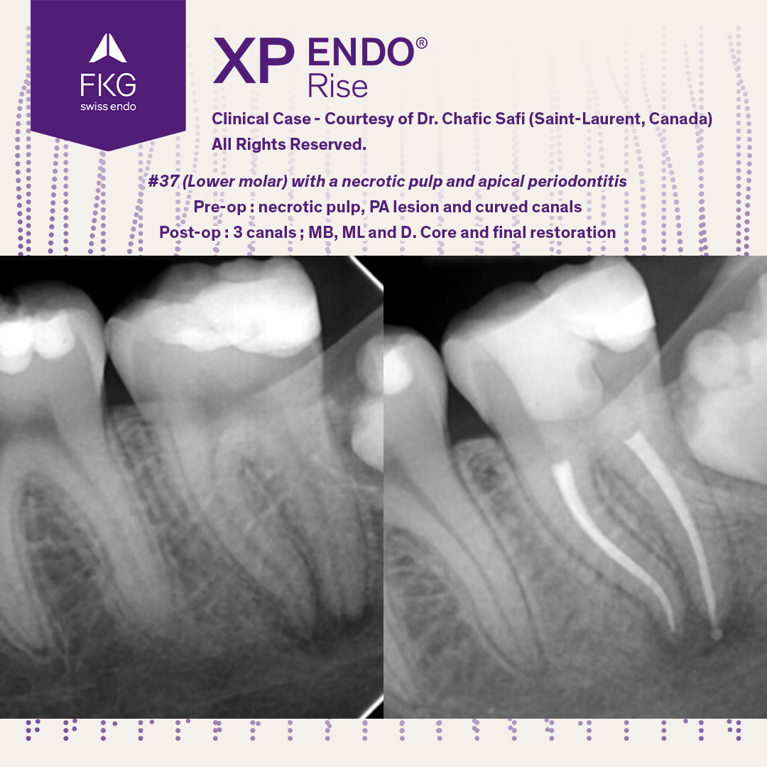 FKG Dentaire - 🤩 Treatment of a necrotic pulp and apical...