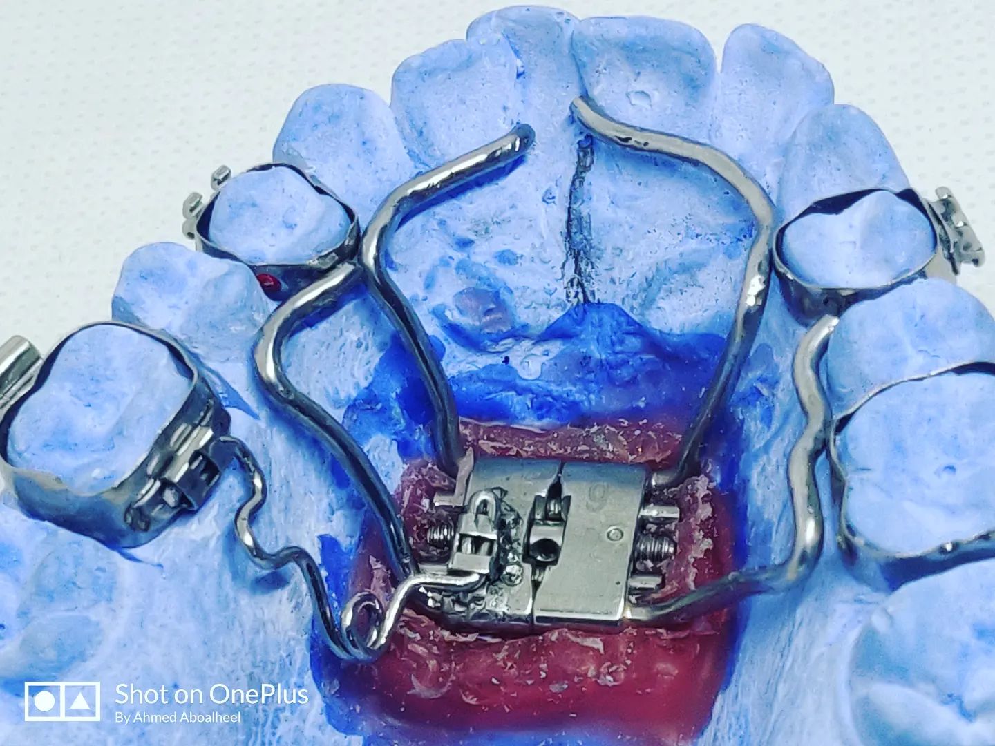 Modified R.P.E with unilateral... - Ortho Design laboratory | Facebook
