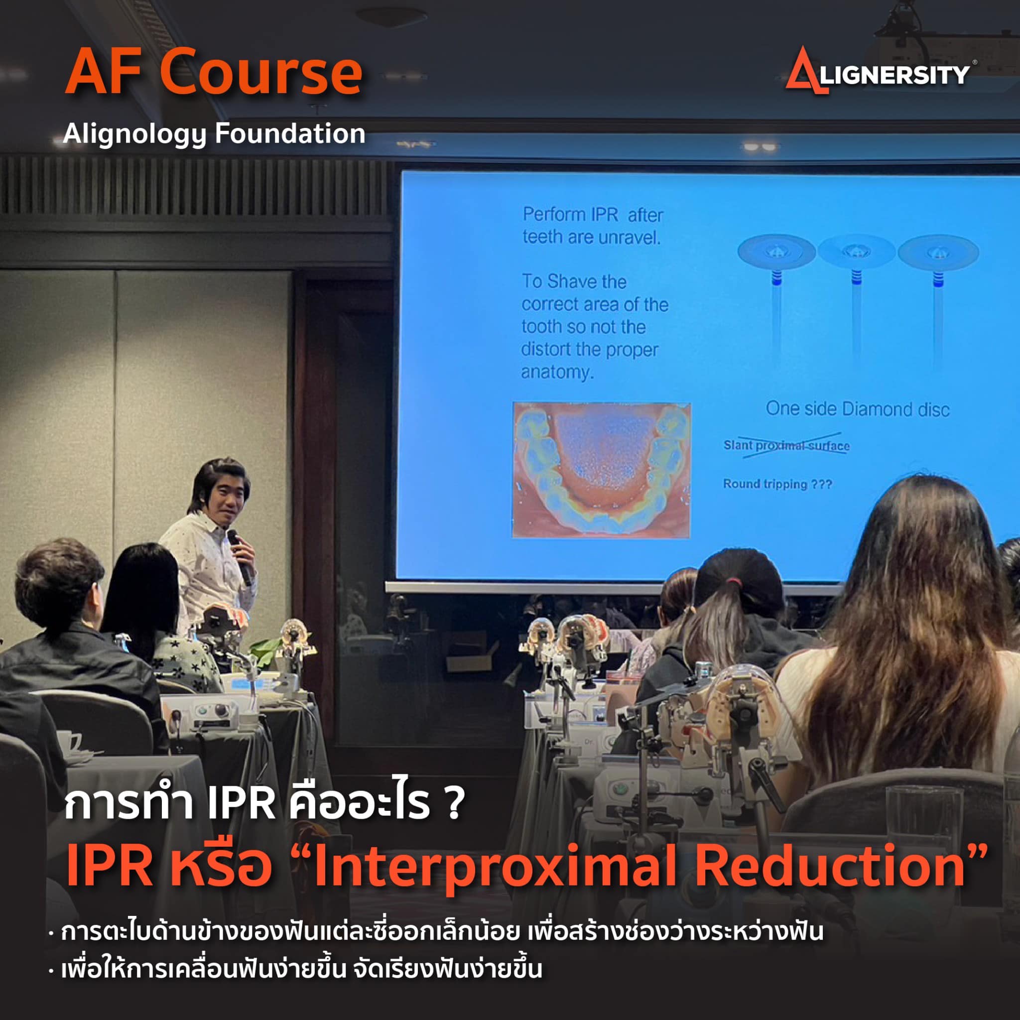 Alignersity - 🔑 Interproximal Reduction หรือ IPR 🔑... | Facebook
