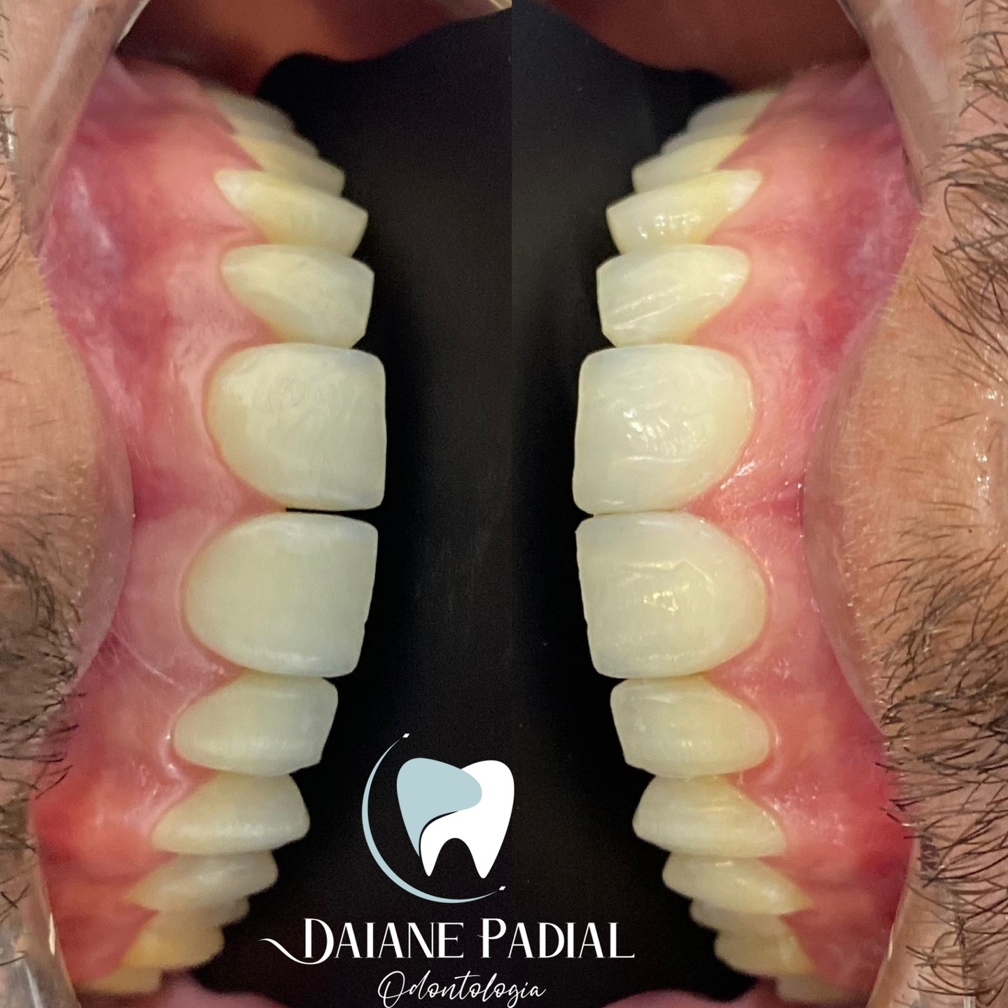 Padial - 🦷 Fechamento de Diastema, pequeno porém principal queixa do ...