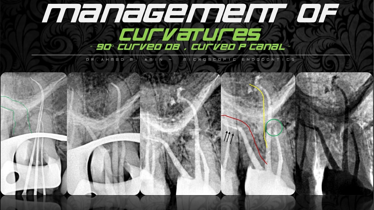 Techniques for managing curved root canals