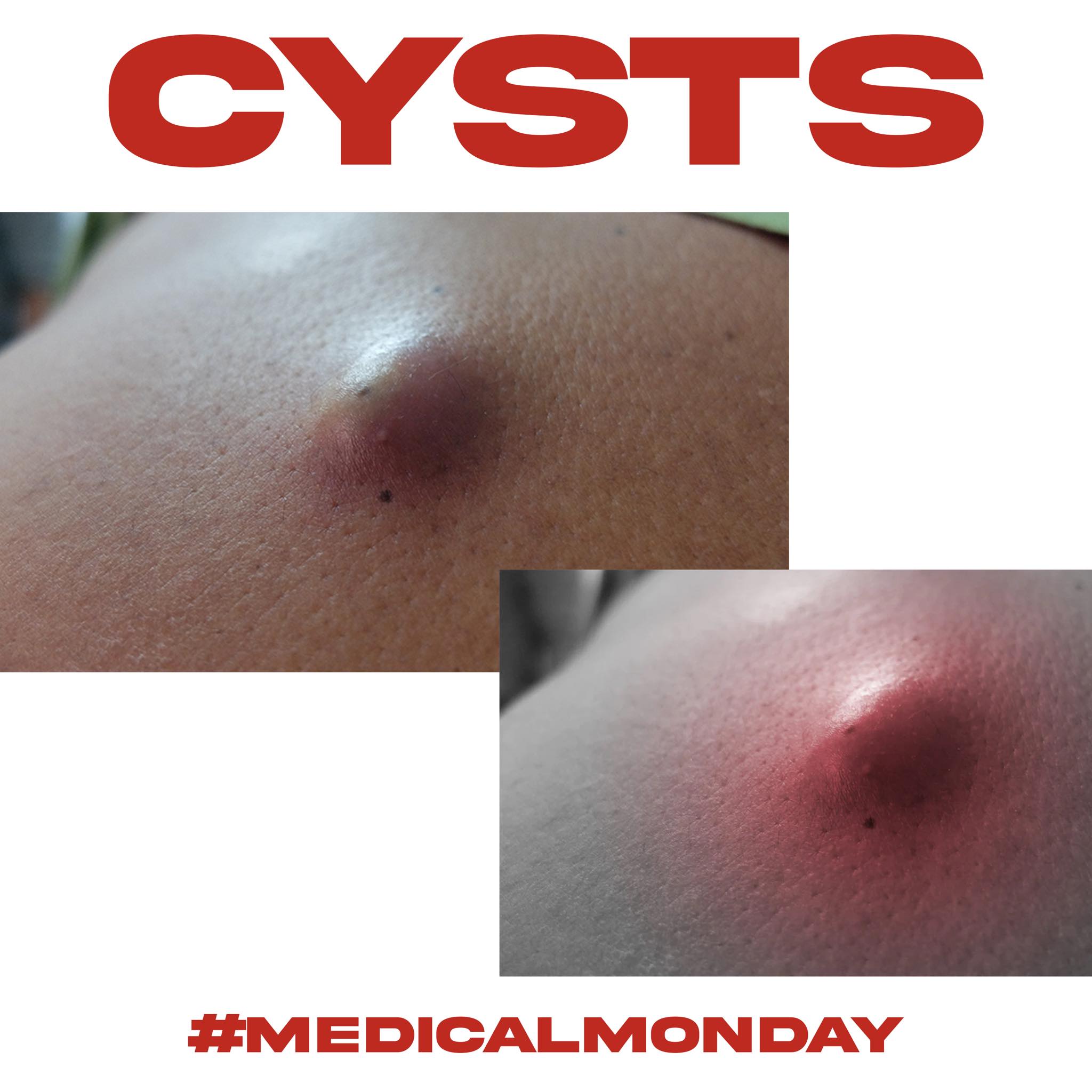 Dr. - Cysts, also known as Epidermal Inclusion Cysts, are caused by an ...