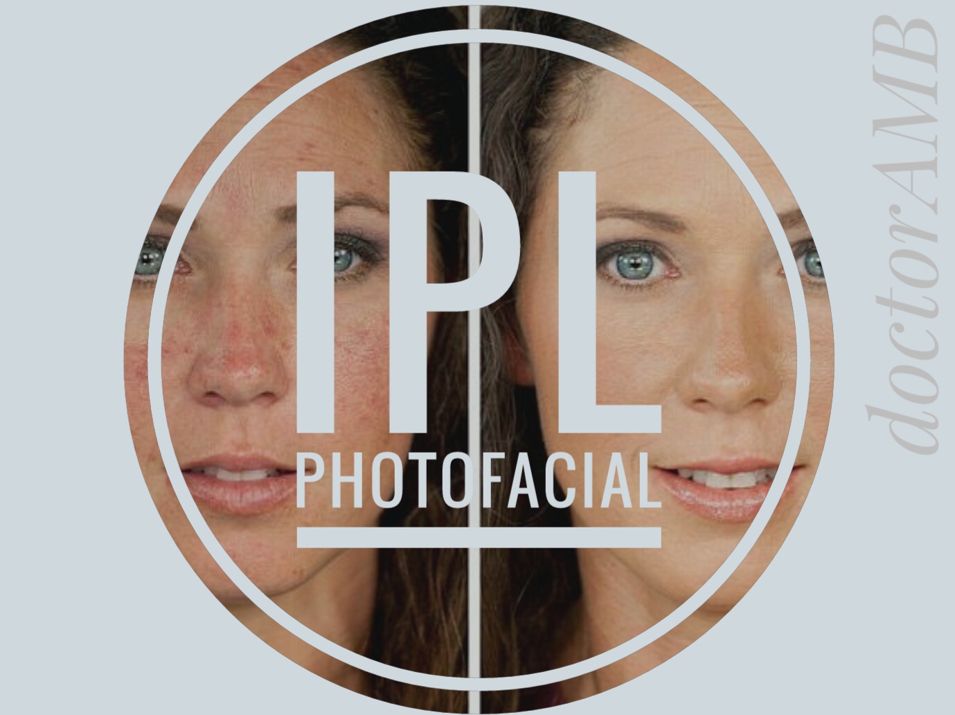 Las Vegas Laser Med Spa - •IPL- PHOTOFACIAL SKIN REJUVENATION• IPL ...