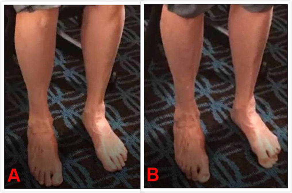Below is a link to a new report from... - Orthostatic Tremor | Facebook