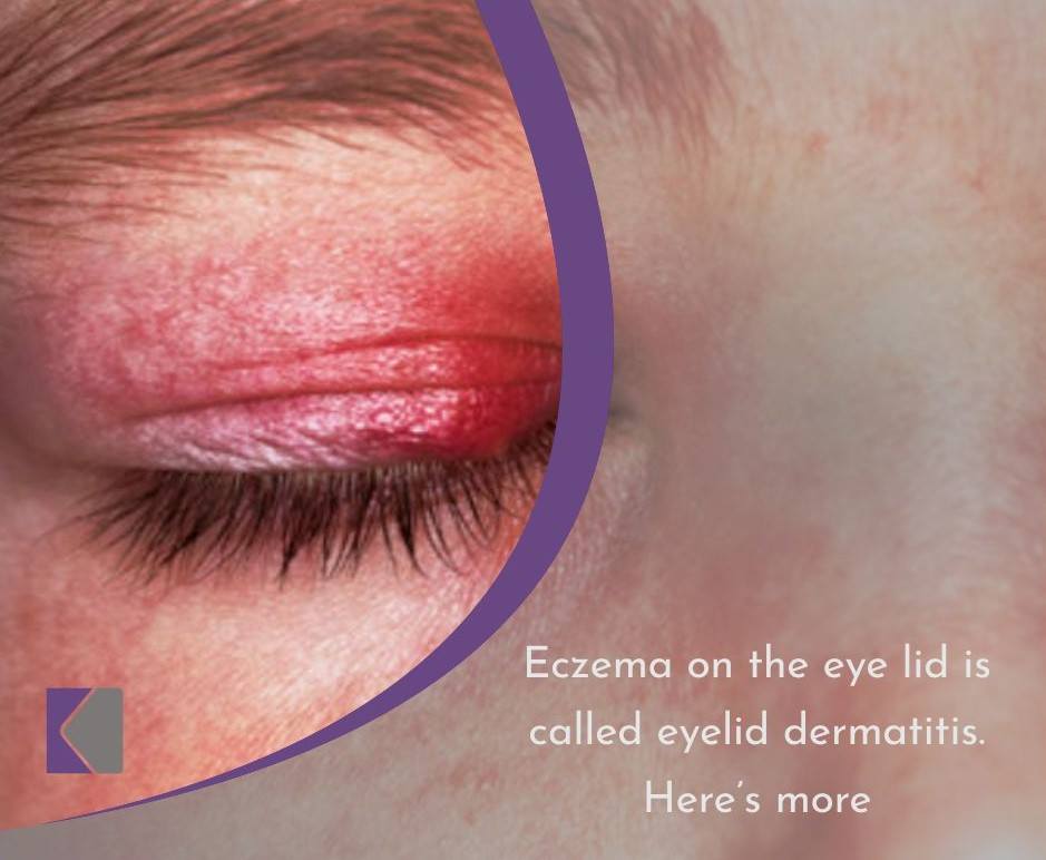 eyelid-eczema-eczema-on-kampala-dermatology-skin-clinic