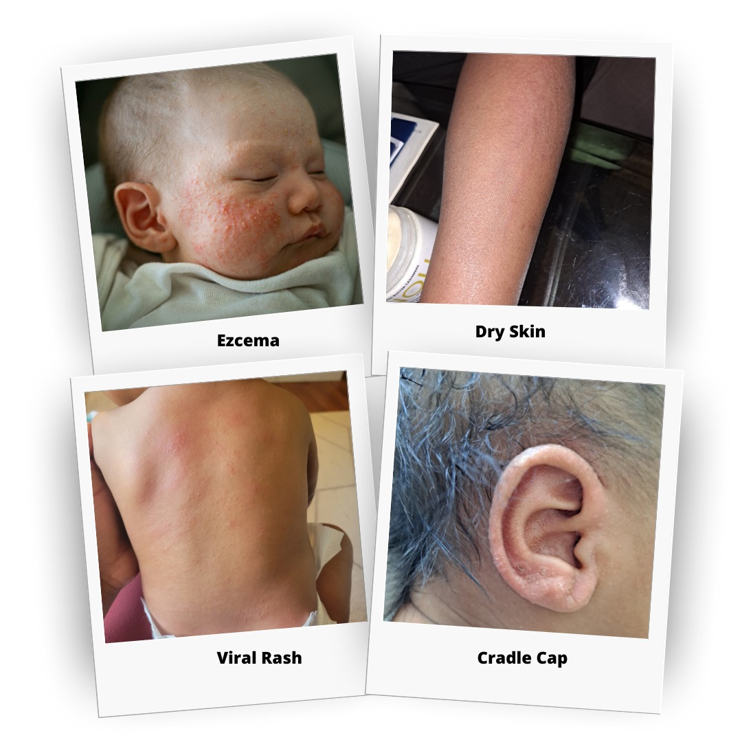 Noli - Not all dry, irritated skin is eczema. Some winter rashes mimic ...