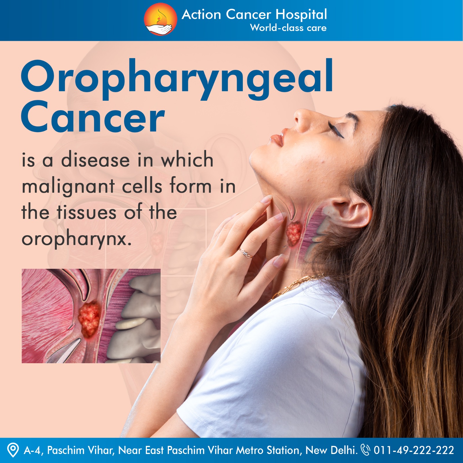Oropharyngeal cancer is a disease... - Action Cancer Hospital