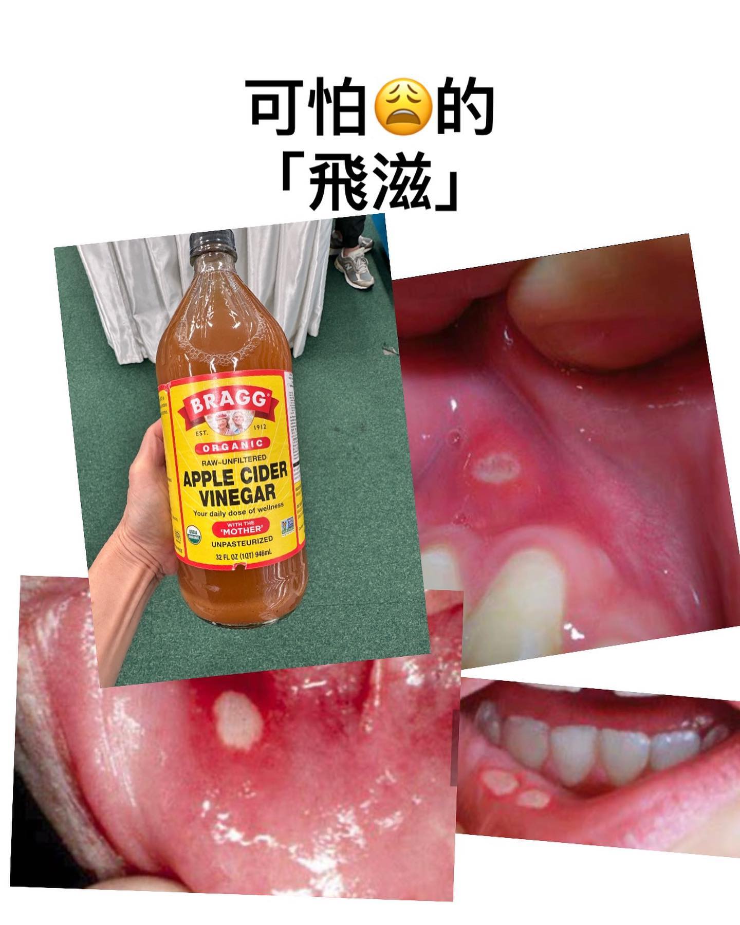 好多人都遇到過生「#飛滋」（#痱滋）Canker sores... - HealthQuest Dr.Mao茅博士