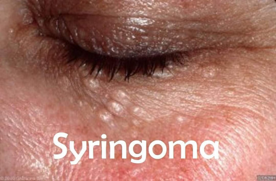 MarSan - Ang SYRINGOMA ay sweat duct cyst. 