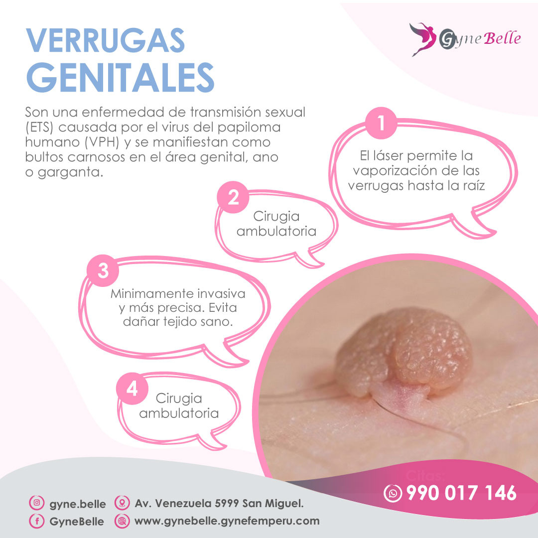 Gyne - 🔍 ¿Sabías que las verrugas genitales son una de las ITS más ...