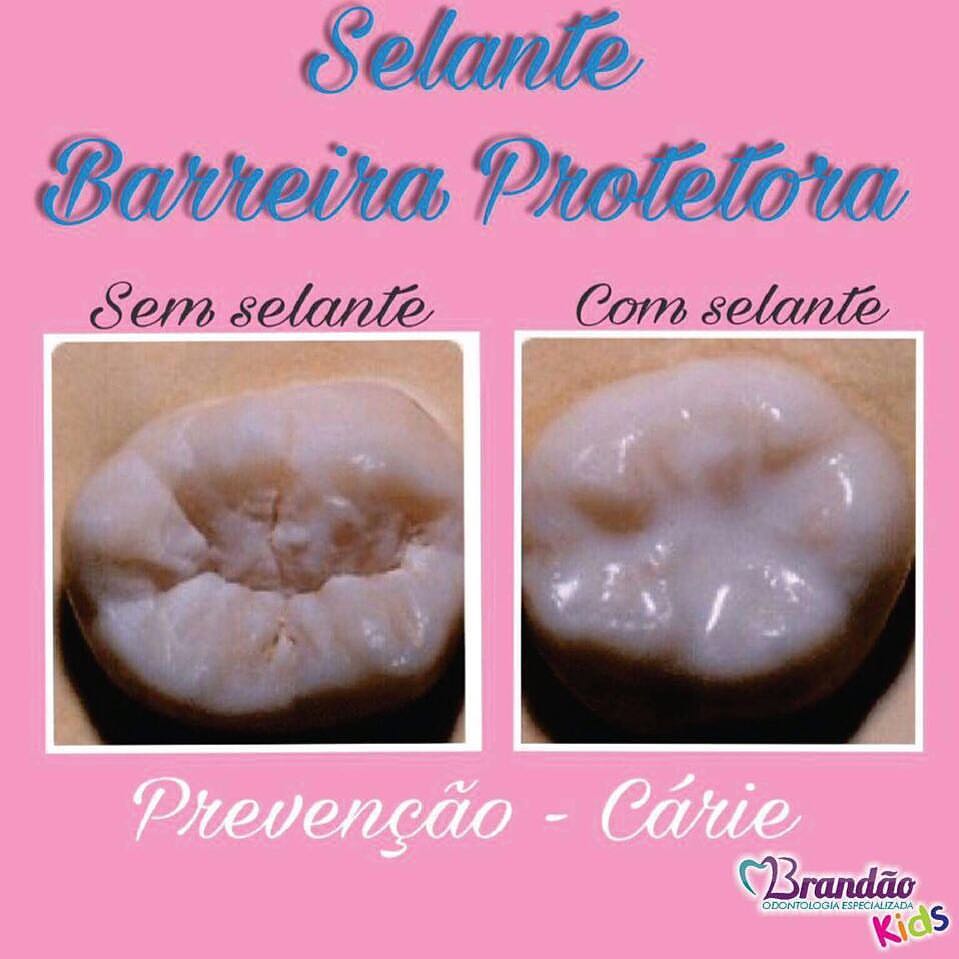 dra-francielli-brand-o-odontopediatria-cuiab-o-que-selante-para
