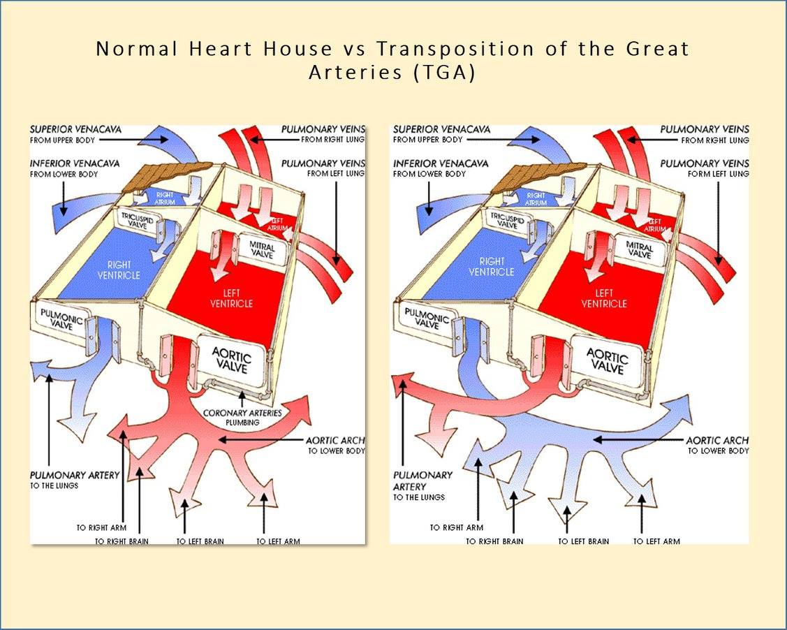 Let it ECHO - Transposition of the Great Arteries is a problem with the ...