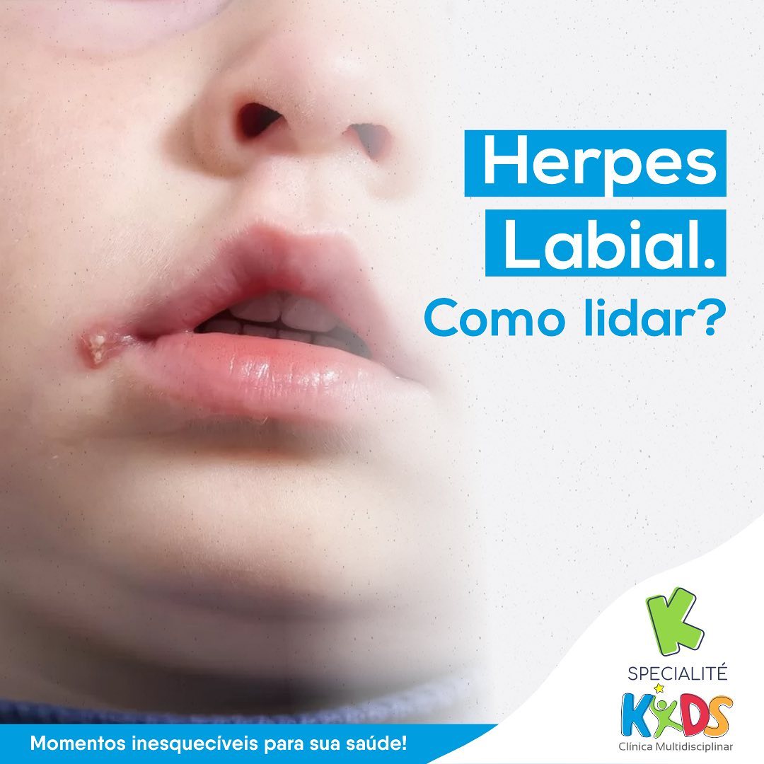 Specialité - 👄 O herpes labial é uma infecção causada pelo vírus herpes ...