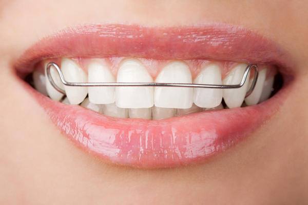 Dean Furkioti Dds We Make Retainers For Simple Tooth Movement To Better Align Your Teeth Http Www Furkioti Com 310 540 4882 Facebook