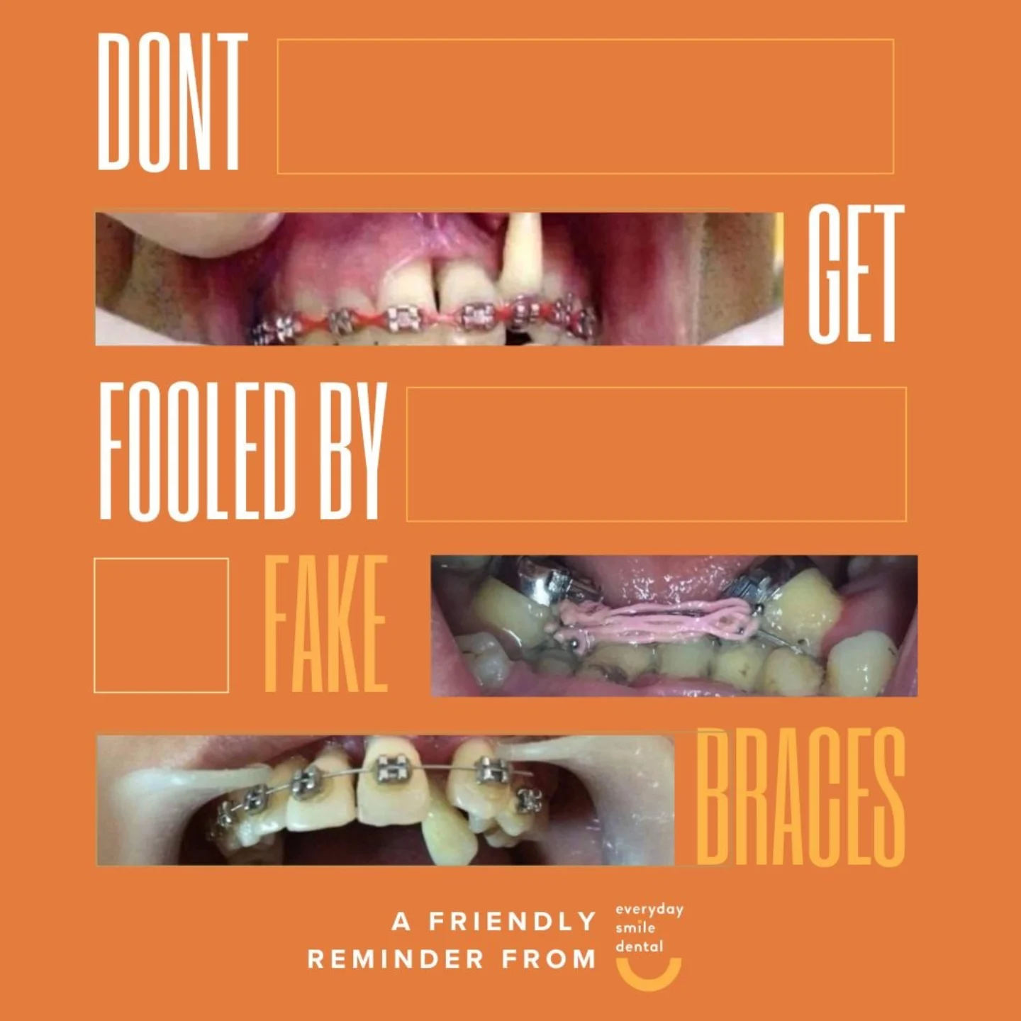 EverydaySmile - Don’t Fall for Fake Braces! Fake braces may seem like a ...