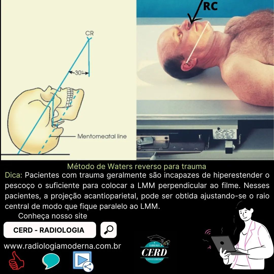 Radiologia - Crânio e ossos da face - Método de Waters Reverso para ...