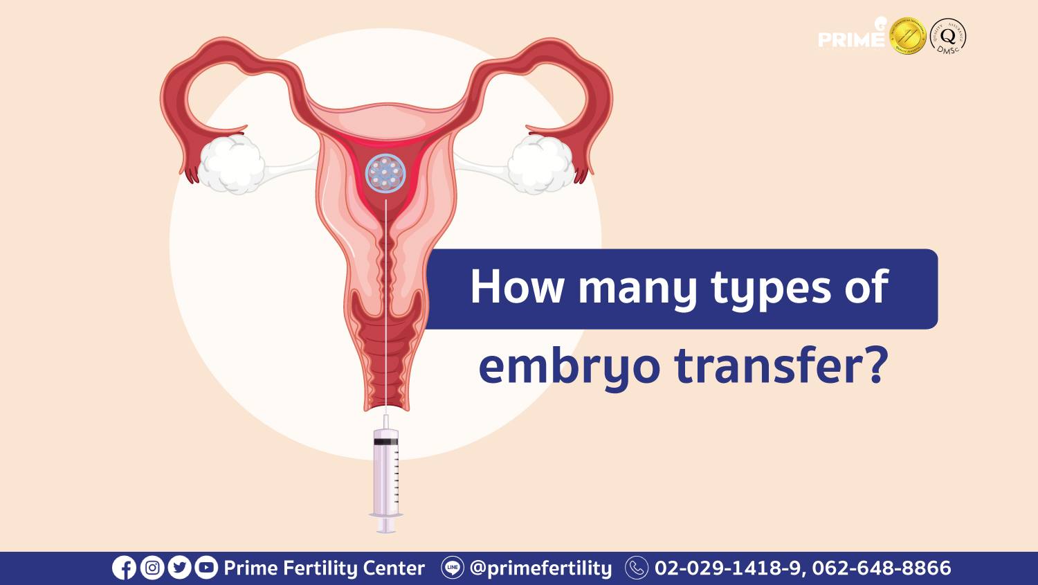 Prime - How many types of embryo transfer? Fresh Embryo Transfer A ...