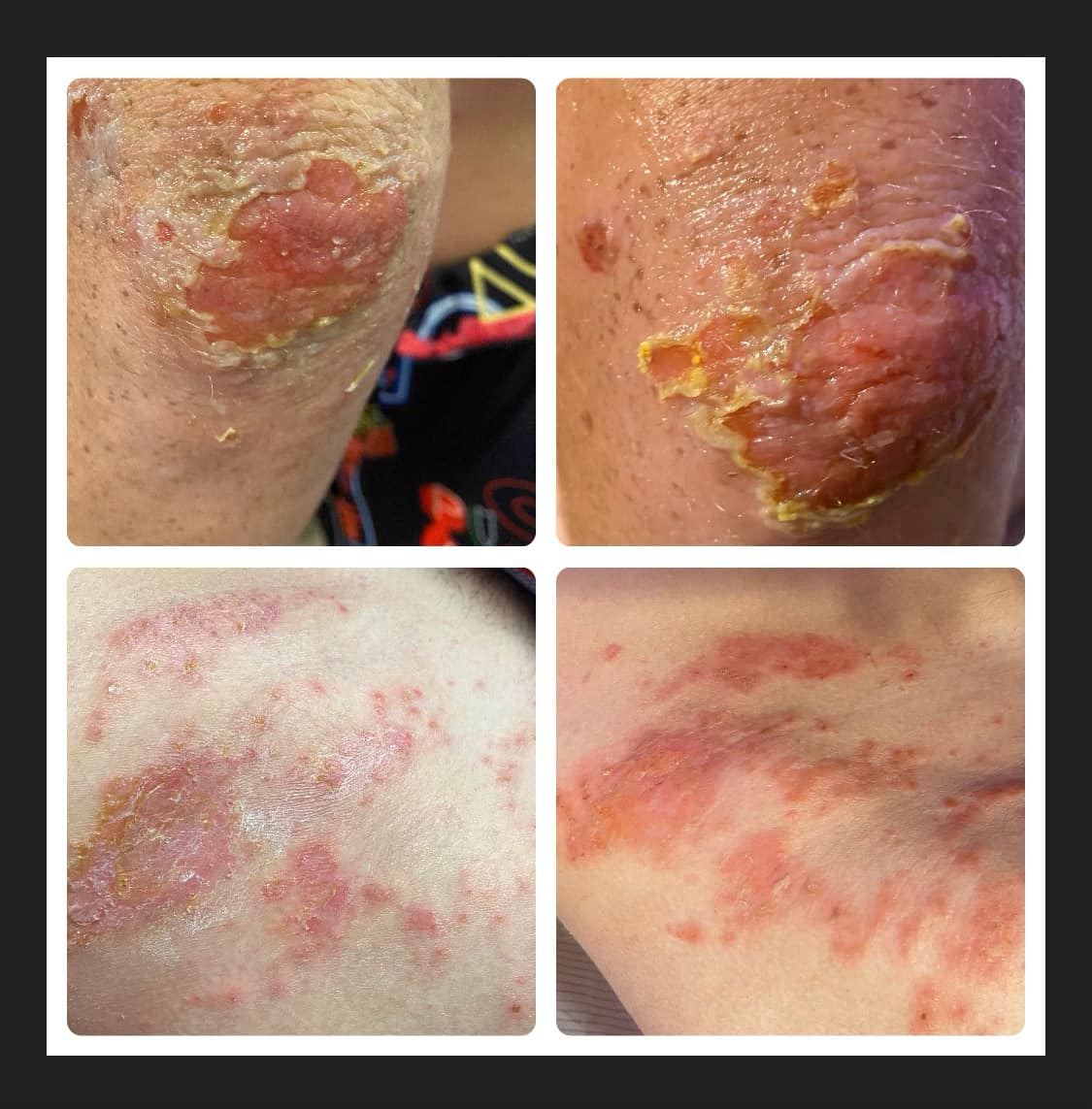 Get Compel - Turf burn infected by impetigo before during...