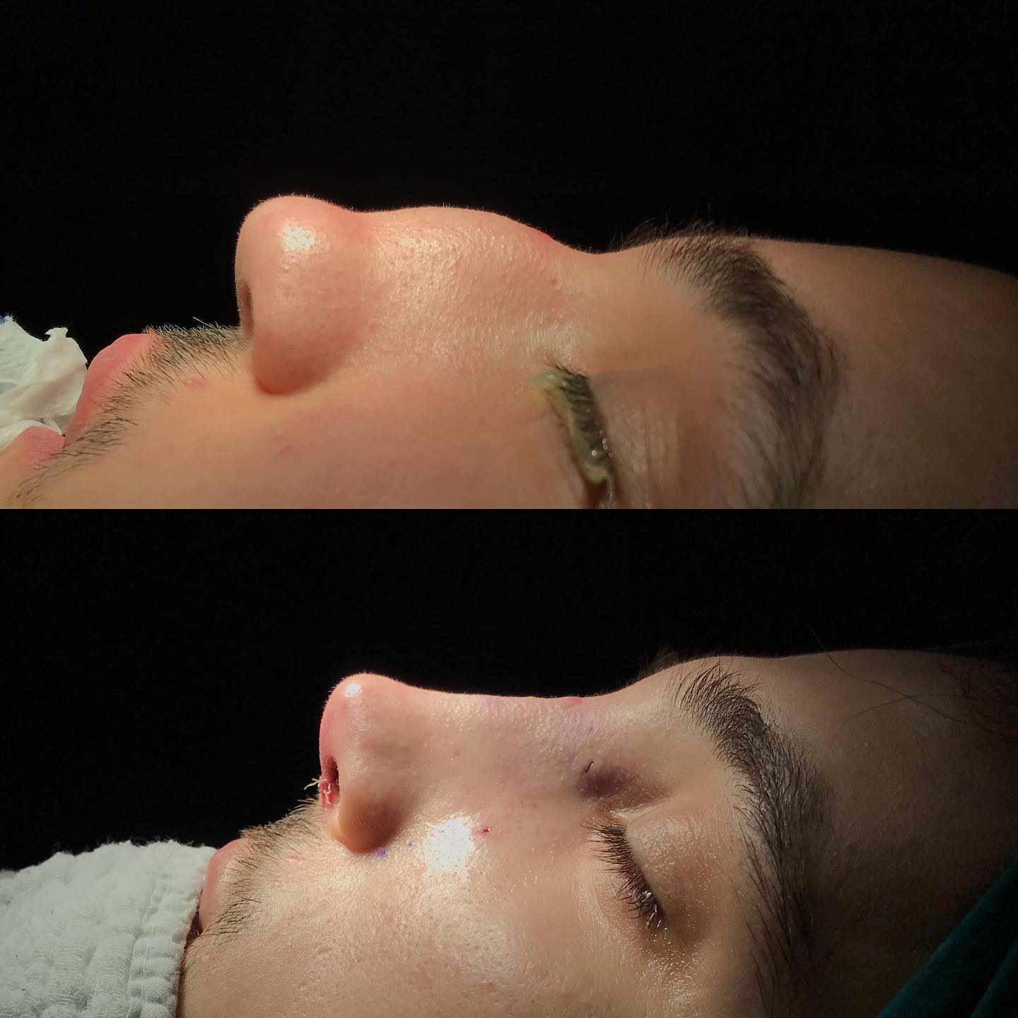 Beykoz Tıp - Another challenging nose, traumatic nose,... | Facebook