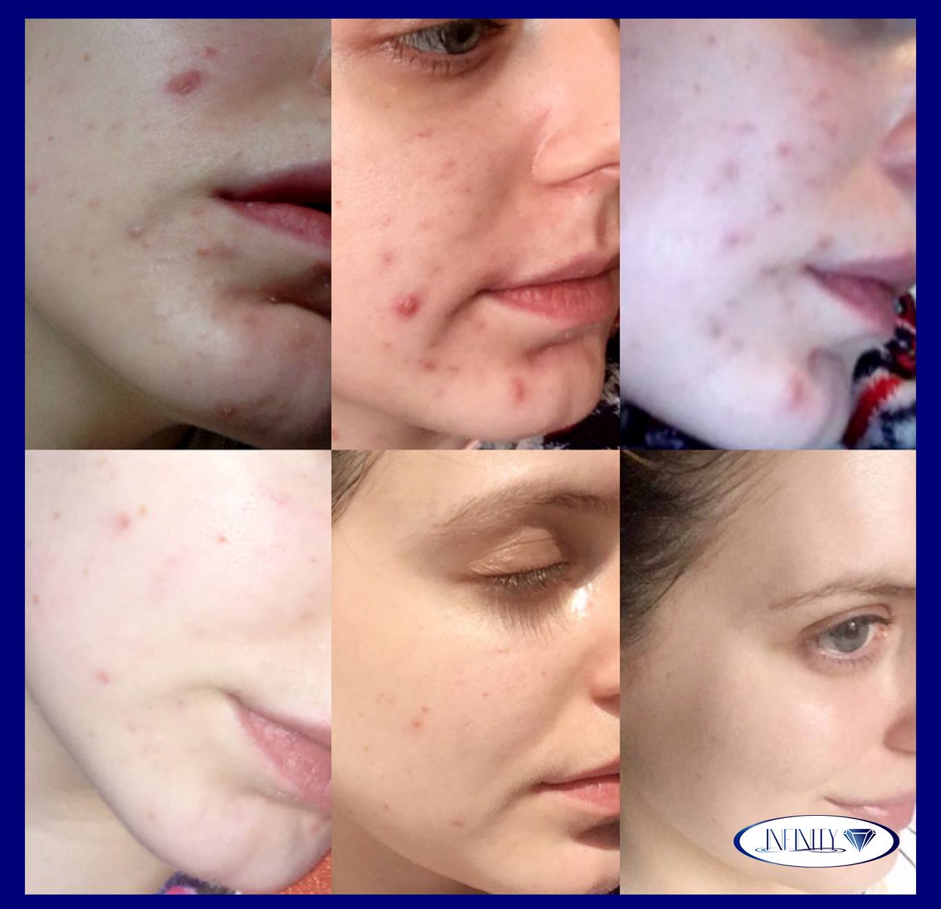 🔷Conoce crema natural... - Infinity / Tratamientos para acné