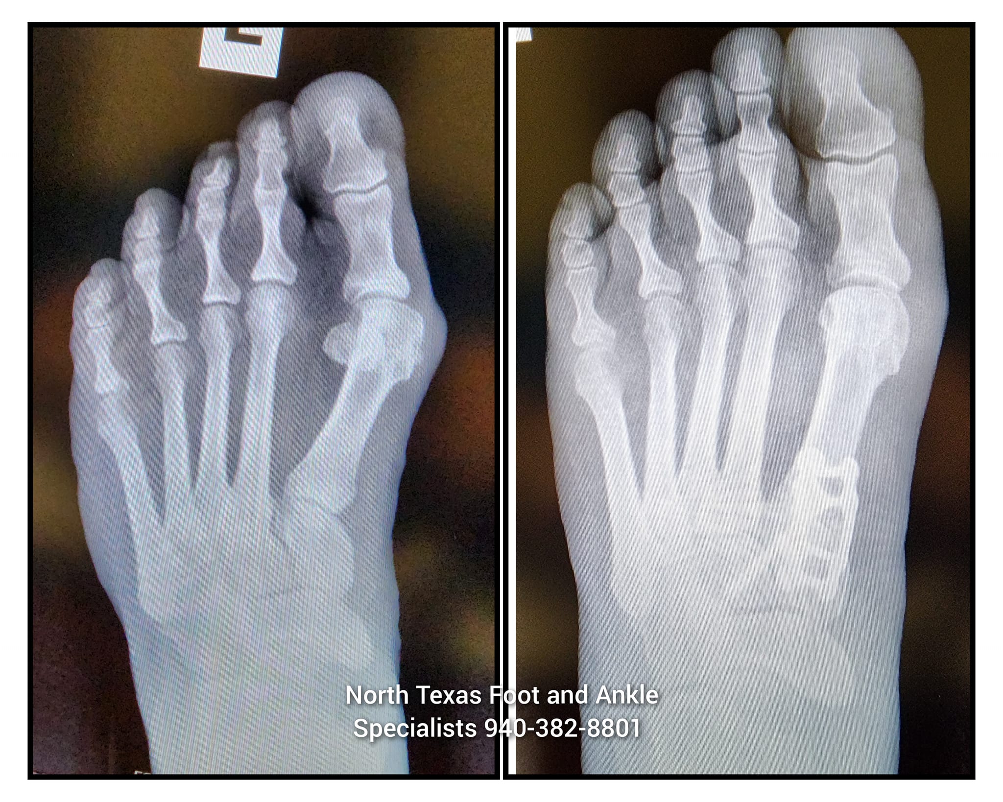 Lapiplasty... - North Texas Foot and Ankle Specialists, P.C.