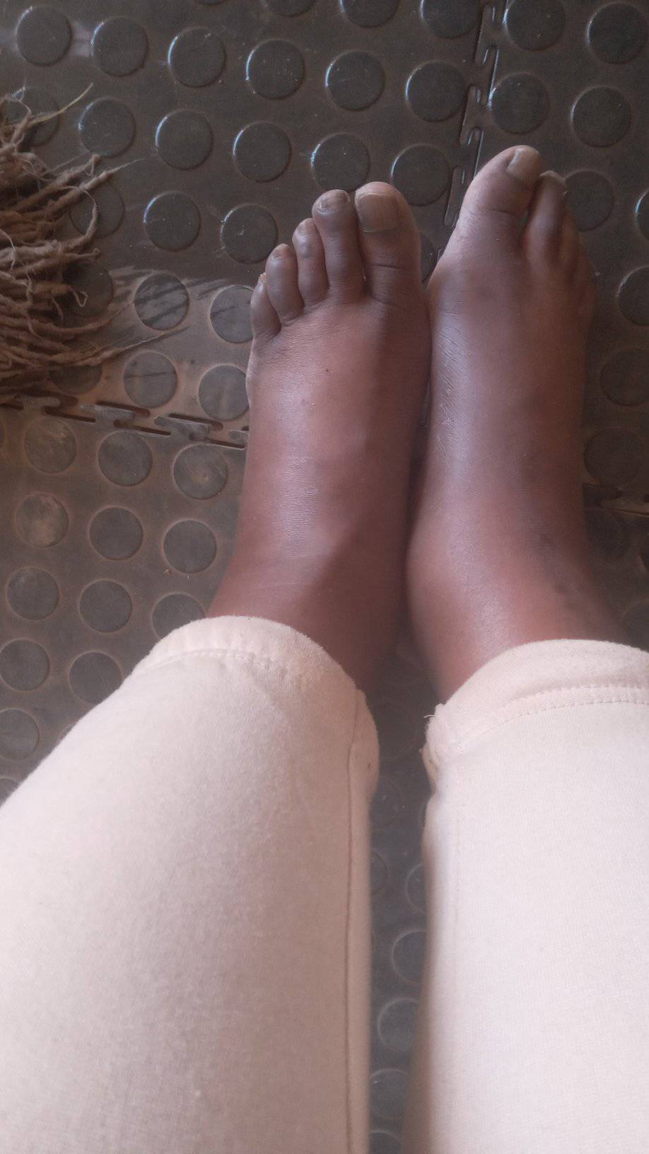 What to do about swollen legs caused by high blood pressure medication?