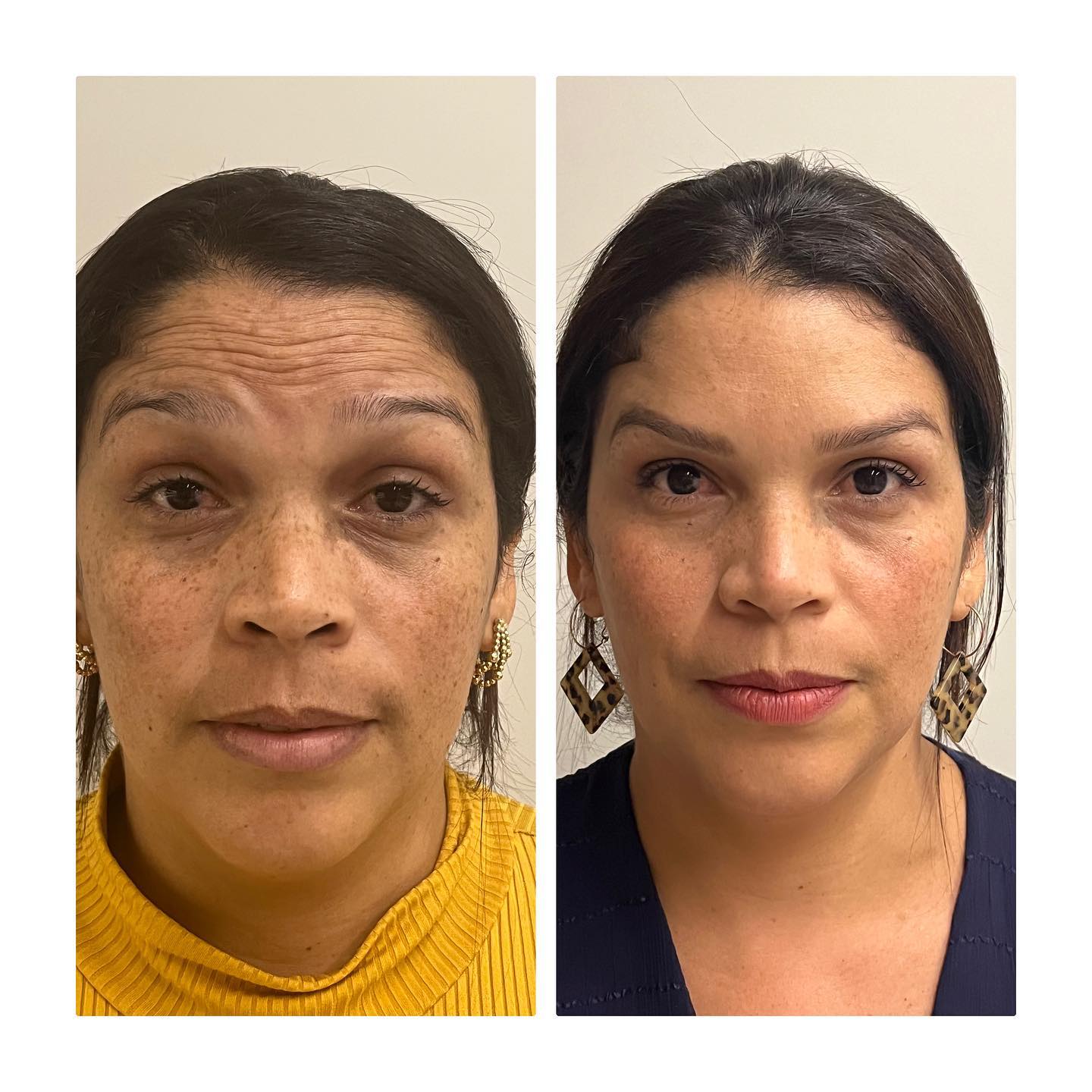 Botox antes e depois Paciente ficou... - harmonizenoroeste