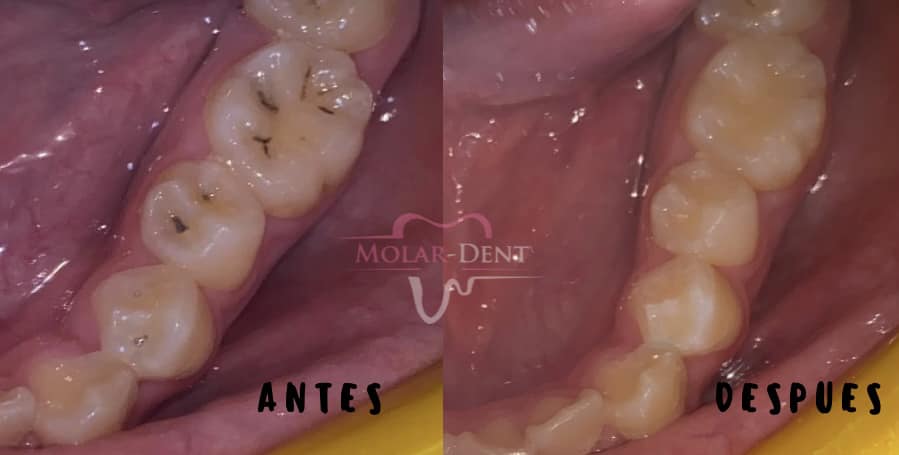 C.D. - La resina dental se utiliza para reemplazar una parte cariada o ...