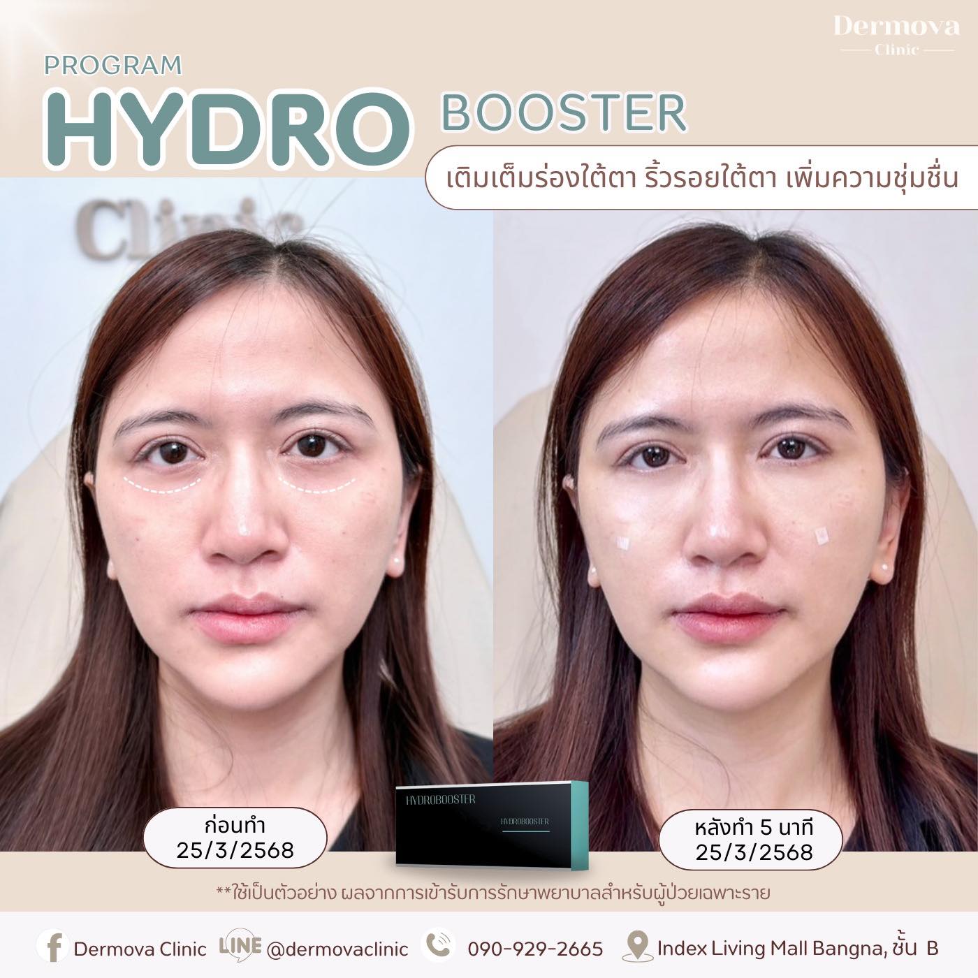 Dermova - รีวิวสุดจึ้ง โปรแกรมไฮโดรบูสเตอร์ใต้ตา 🩵💧 บอกตาใต้ตาคล้ำ ตา ...