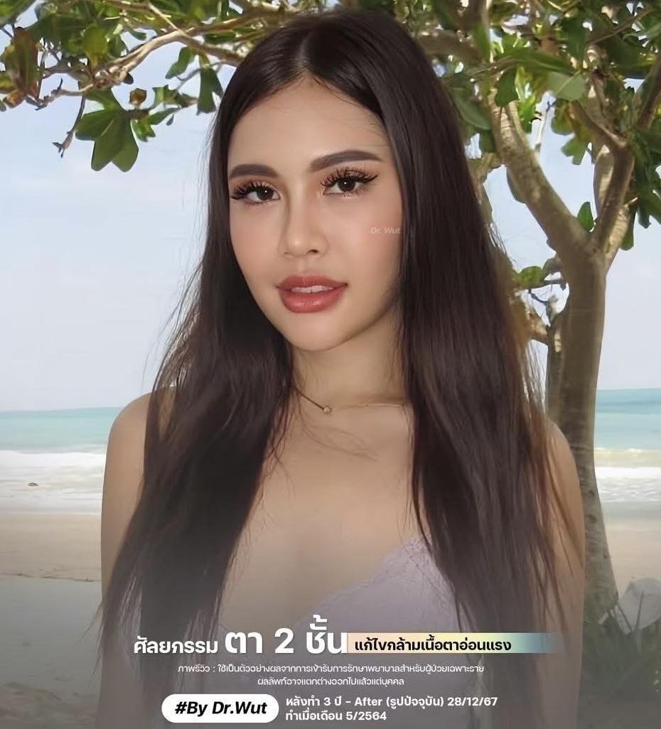อาย - Review ตาสองชั้น (หลังทำ 3 ปี ) 👉🏻สามารถนัดเข้ามาปรึกษาและประเมิน ...