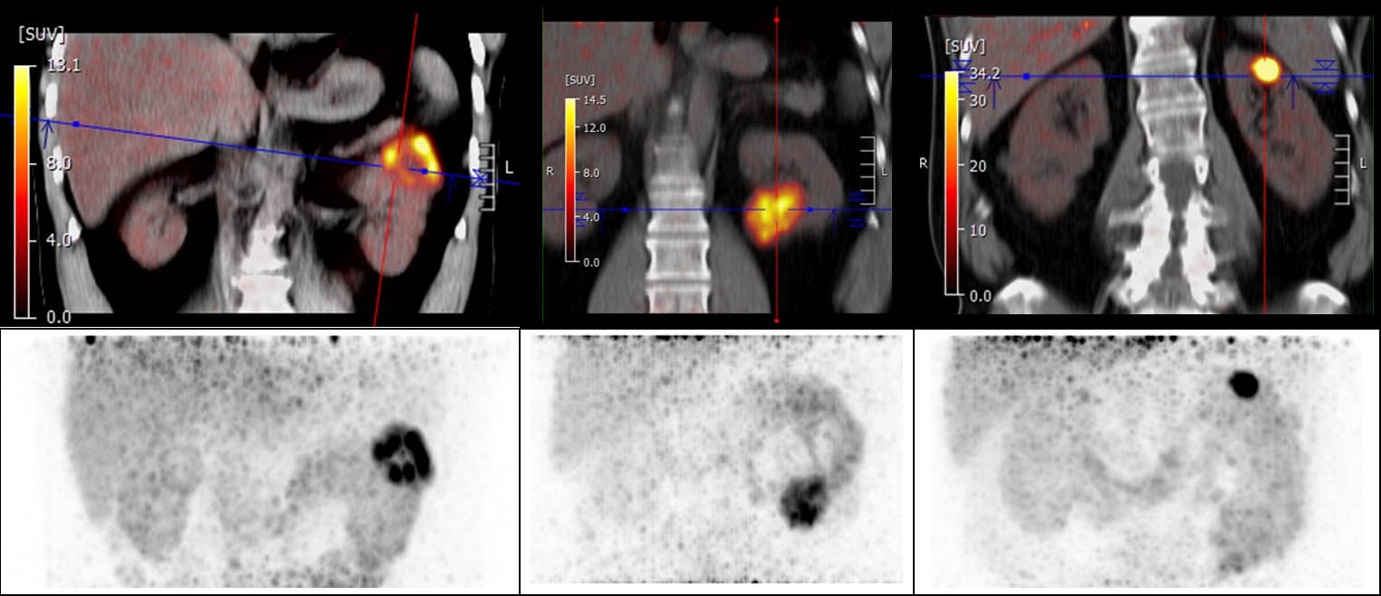#SNMMI2... - Society of Nuclear Medicine and Molecular Imaging